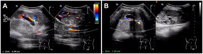 Multimodality imaging of Xp11.2 translocation/TFE3 gene fusion associated with renal cell carcinoma: a case report